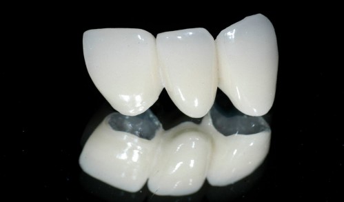 cấu tạo răng sứ cercon 1