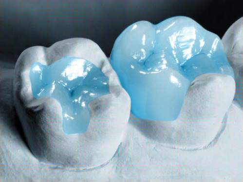 Độ bền sử dụng của miếng trám composite 2