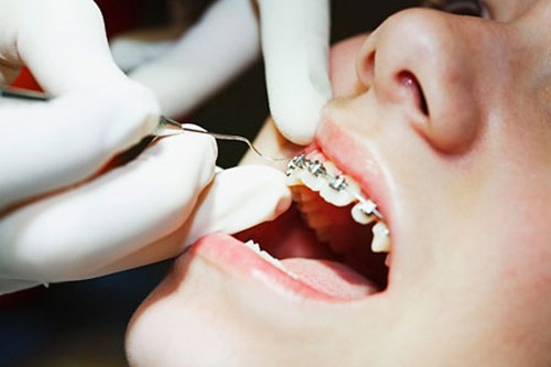 Răng vẩu có di truyền niềng răng vẩu 4
