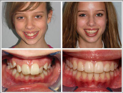 Răng vẩu có di truyền niềng răng vẩu 5