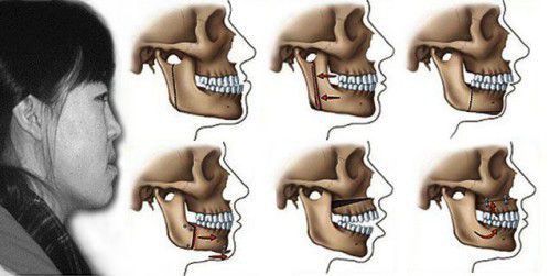 Răng vẩu có di truyền niềng răng vẩu 3