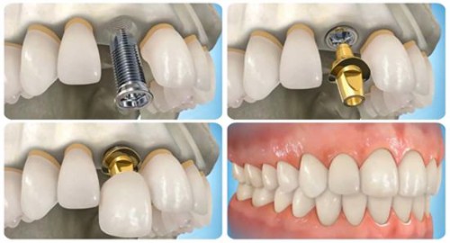Trồng răng hàm giả bằng cấy răng implant 2