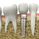 Trồng răng hàm giả bằng cấy răng implant