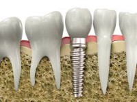 Trồng răng hàm giả bằng cấy răng implant