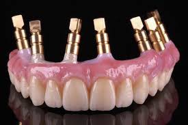 Trồng răng hàm giả bằng cấy răng implant 4