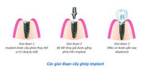 Trồng răng hàm giả bằng cấy răng implant 3