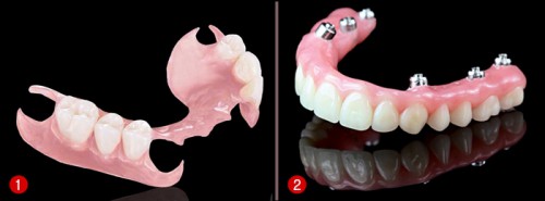 Trồng răng hàm giả cố định và hàm giả tháo lắp 2