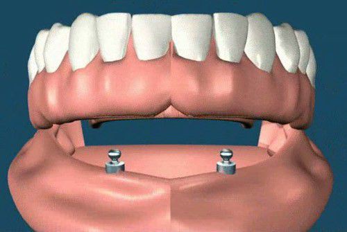 Trồng răng hàm giả cố định và hàm giả tháo lắp 5