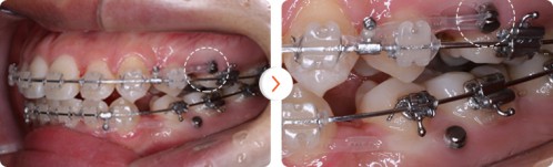 Các hệ thống mắc cài sử dụng trong niềng răng