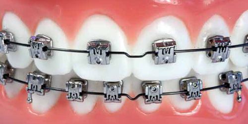 Các hệ thống mắc cài sử dụng trong niềng răng