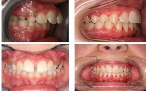 Điều trị niềng răng hô 2