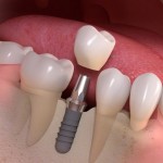 Trồng răng implant mất bao lâu ?