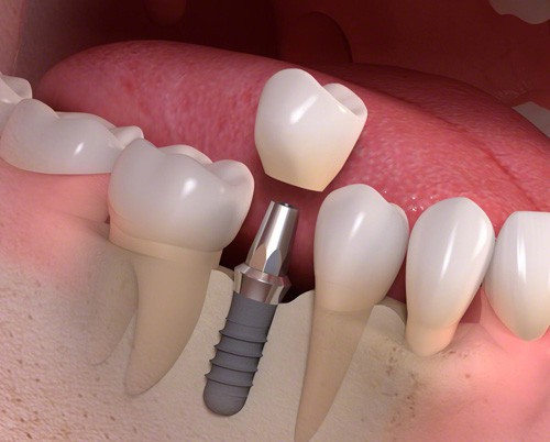 Trồng răng implant mất bao lâu? 1