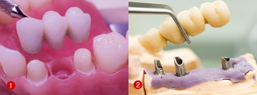 Các phương pháp làm răng giả cố định 1