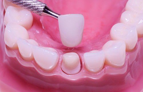 Ưu và nhược điểm của trồng răng sứ cố định
