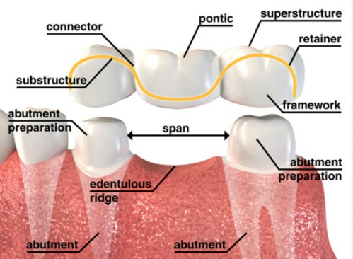 Những hạn chế của phương pháp cầu răng 1