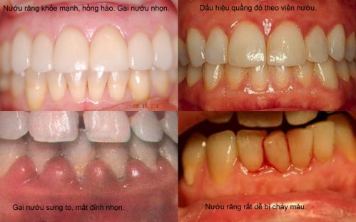 Những biến chứng sau bọc răng sứ thẩm mỹ