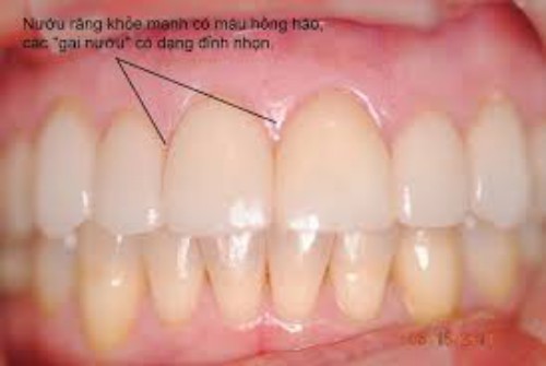 Các bệnh về răng miệng 2