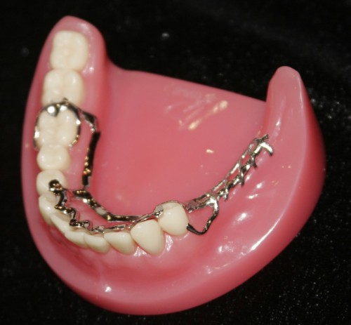 Các kiểu làm răng giả nguyên hàm 2