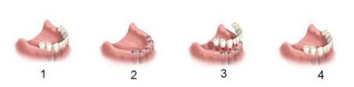 Các kiểu làm răng giả nguyên hàm 5