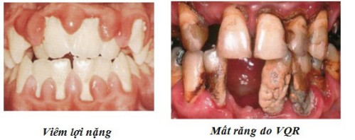 Các nguyên nhân gây bệnh viêm quanh răng 2
