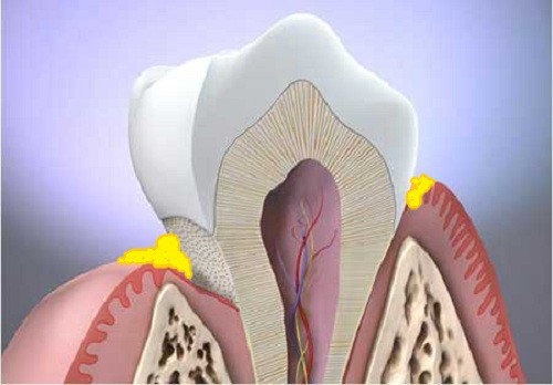 Các nguyên nhân gây bệnh viêm quanh răng 1