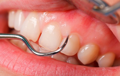 Cách xử lý hôi miệng sau khi bọc răng sứ 1