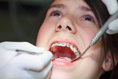 Cách điều trị răng hô hiệu quả 5