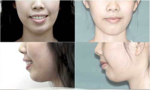Cách điều trị răng hô hiệu quả 1
