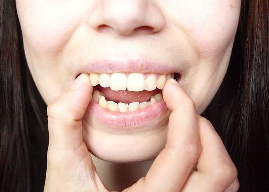 Chữa hô răng triệt để tại nha khoa 2