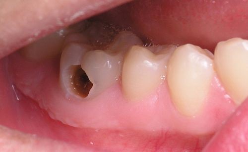 Chữa bệnh sâu răng cho trẻ em 1