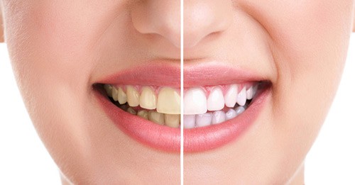 Dấu hiệu biểu hiện sâu răng 3