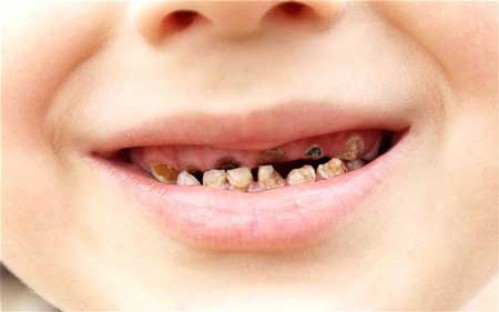 Điều trị và phòng ngừa sâu răng 1