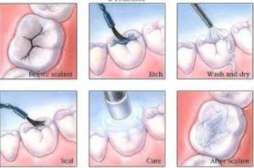 Điều trị và phòng ngừa sâu răng 3