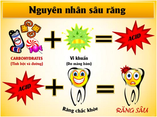 Điều trị và phòng ngừa sâu răng 2