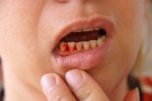 Nguy cơ sức khỏe khi bị chảy máu chân răng