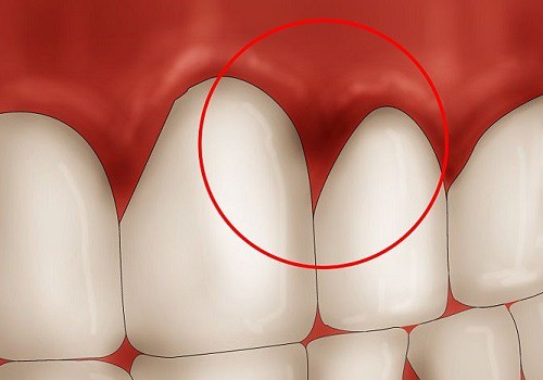 Các bệnh về răng miệng 5