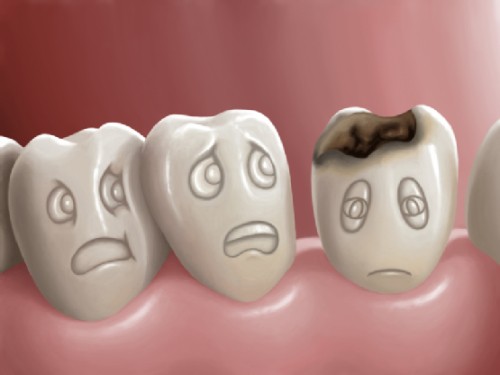 Nguyên nhân bị đau răng 1