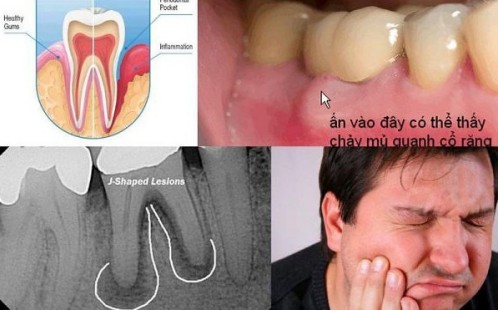 Nguyên nhân dẫn đến viêm tủy sau bọc răng sứ 2