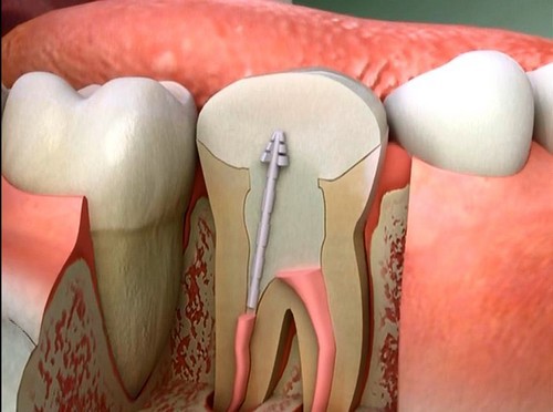 Nguyên nhân dẫn đến viêm tủy sau bọc răng sứ