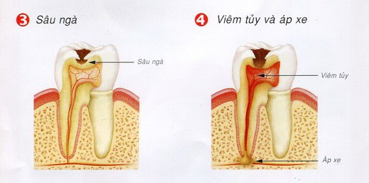 Những sai lầm thường gặp khi mắc bệnh sâu răng 5