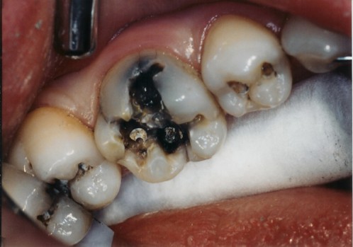 Những sai lầm thường gặp khi mắc bệnh sâu răng 1