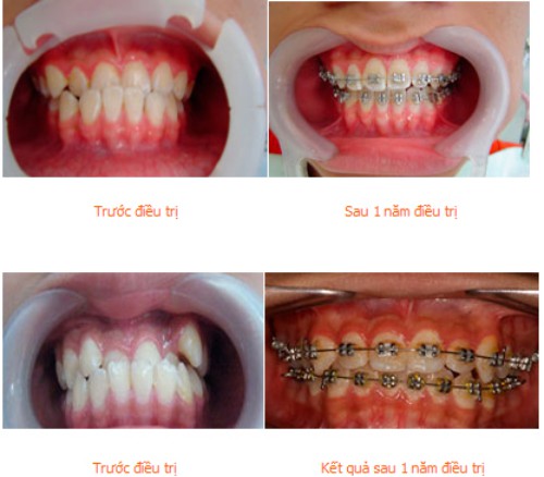Phương pháp điều trị niềng răng móm 1