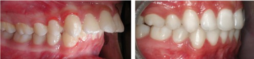 Tiêu chí điều trị hô răng hiệu quả cần đảm bảo 1