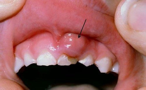 Tổng quan về bệnh viêm lợi
