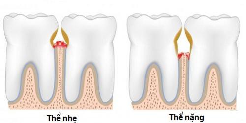 Tổng quan về bệnh viêm lợi