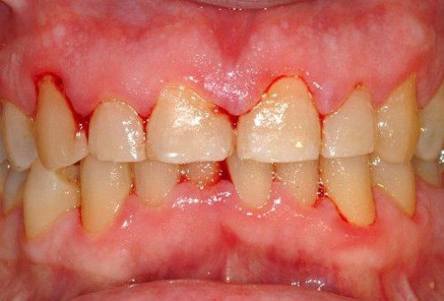 Phân loại thể sâu răng