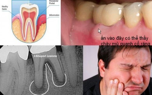 Các loại bệnh quanh răng thường gặp 2