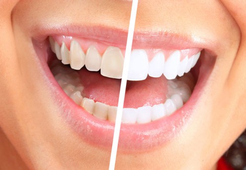 2 cách làm trắng răng tại nhà hiệu quả bất ngờ 6