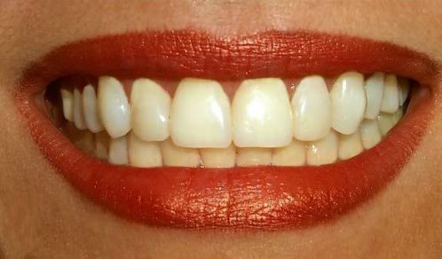 Các nguyên nhân khiến răng bị ố vàng